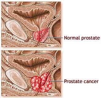Picture of development of prostate cancer.