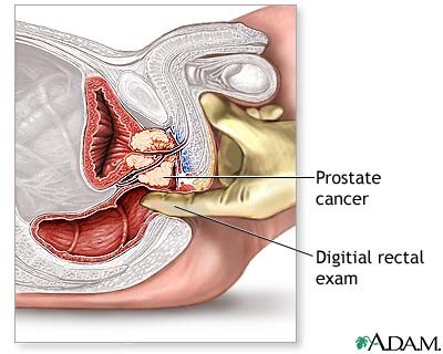 Picture of digital prostate exam being performed.