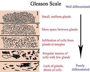 Gleason Scale: well differentiated vs poorly differentiated cells.