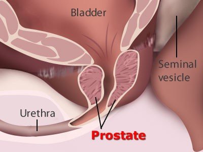 Rendition of enlarged prostate.