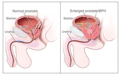 Enlarged Prostate's effect on urination.
