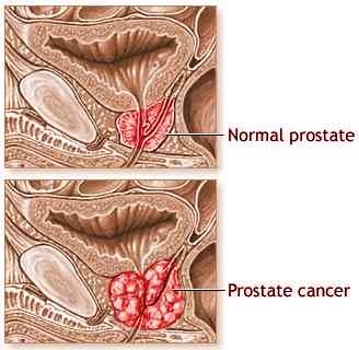 Cancerous prostate gland.