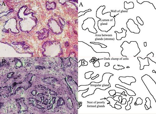 Prostate carcinoma cells under microscope.