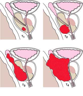 Progression through the 4 stages of prostate cancer.