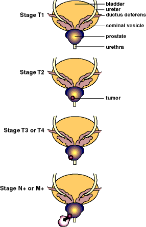 Picture of the stages of prostate cancer.